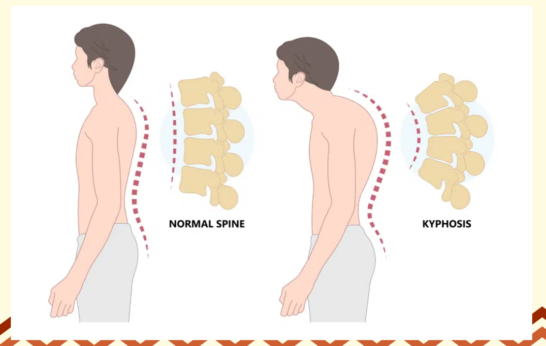 <p>Kyphosis</p>