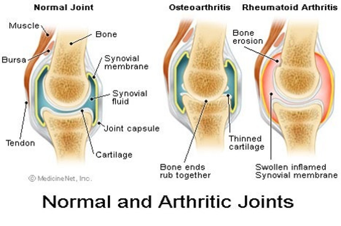 <p>Osteoarthritis</p><p>-individual joints</p><p>-non-inflammatory</p><p>-21 million</p><p>-incidence increases with age</p><p>-slow onset</p><p>-morning stiffness resolves in 20-30 mins</p><p>-NO redness, warmth</p><p>-responds to heat</p><p>-asymmetrical</p><p>Rheumatoid arthritis</p><p>-systemic</p><p>-inflammatory</p><p>-2 million</p><p>-40-60 years, females</p><p>-sudden onset</p><p>-morning stiffness persists for ~1 hr</p><p>-redness, warmth</p><p>-does not respond to heat</p><p>-symmetrical</p>