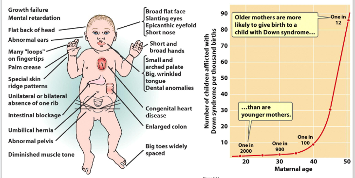 <p>Trisomy 21 Phenotype</p>