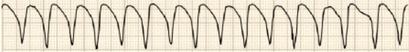 <ul><li><p>rapid heart rhythm originating from ventricles</p></li></ul><p></p>