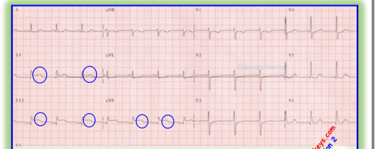 <p>SITE?</p><p>ST elevated Leads on ECG</p><p>Ocluded Artery?</p>