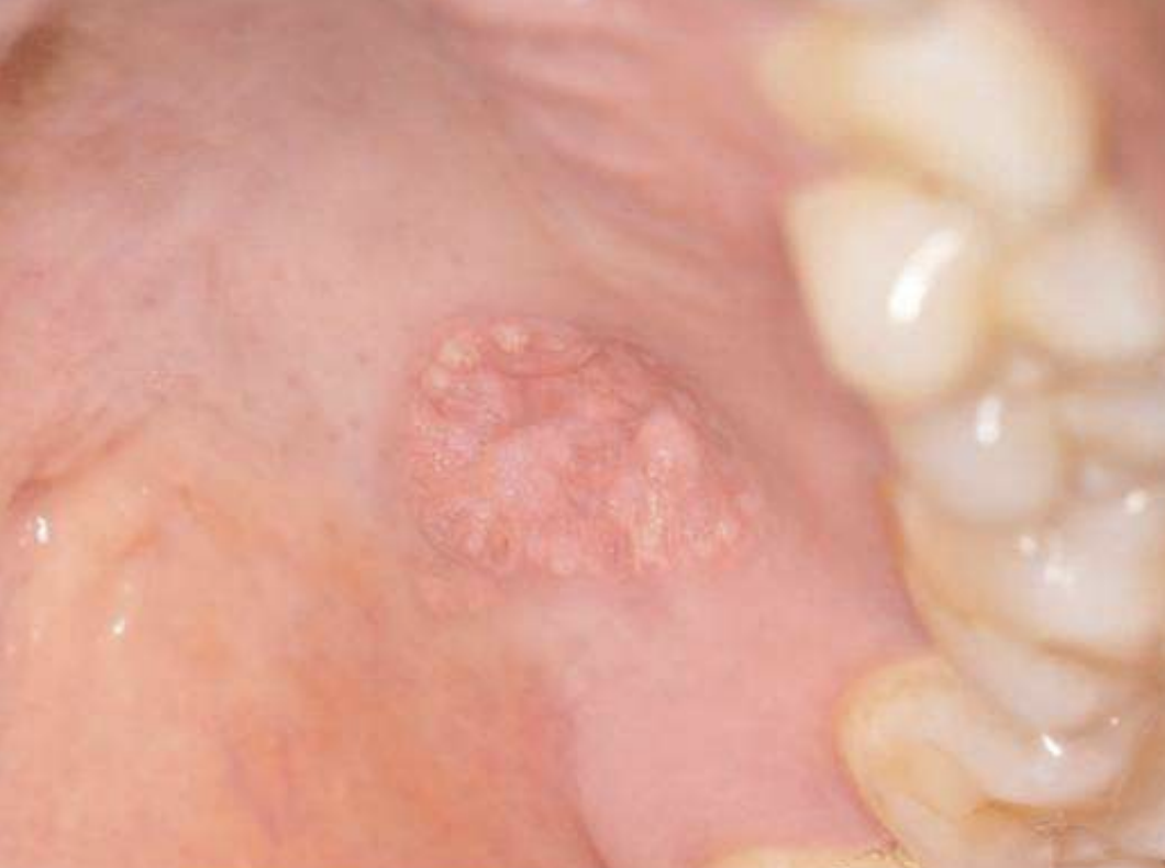 <ul><li><p>hyperplastic epithelium of mouth, skin, and genitalia</p></li><li><p>lipid-laden macrophages beneath epithelium</p></li><li><p>well-demarcated verrucous mass</p></li><li><p>may resemble squamous papillomas or early carcinomas</p></li></ul><p></p><p>What condition?</p>