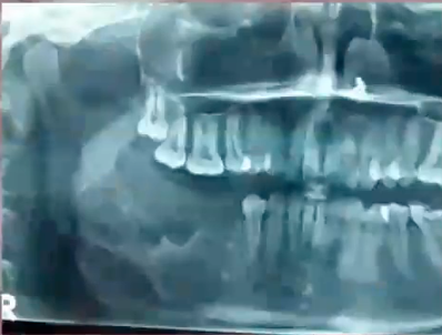 <p>how would you describe this lesion </p>