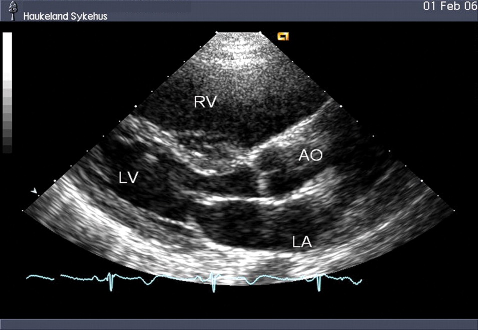 <p>RV dilatation and RV contractility.</p>