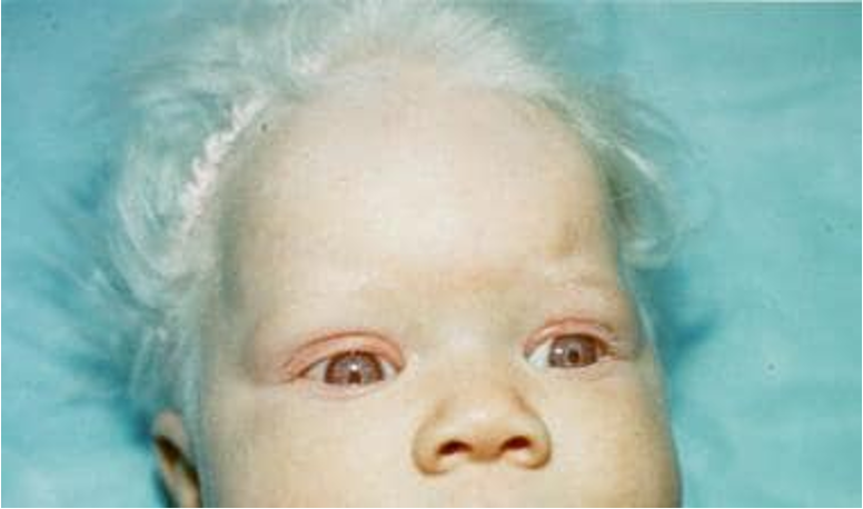 <p>group of inherited abnormalities characterized by congenital reduction or absence of melanin pigment; caused by autosomal recessive genetic alteration</p>