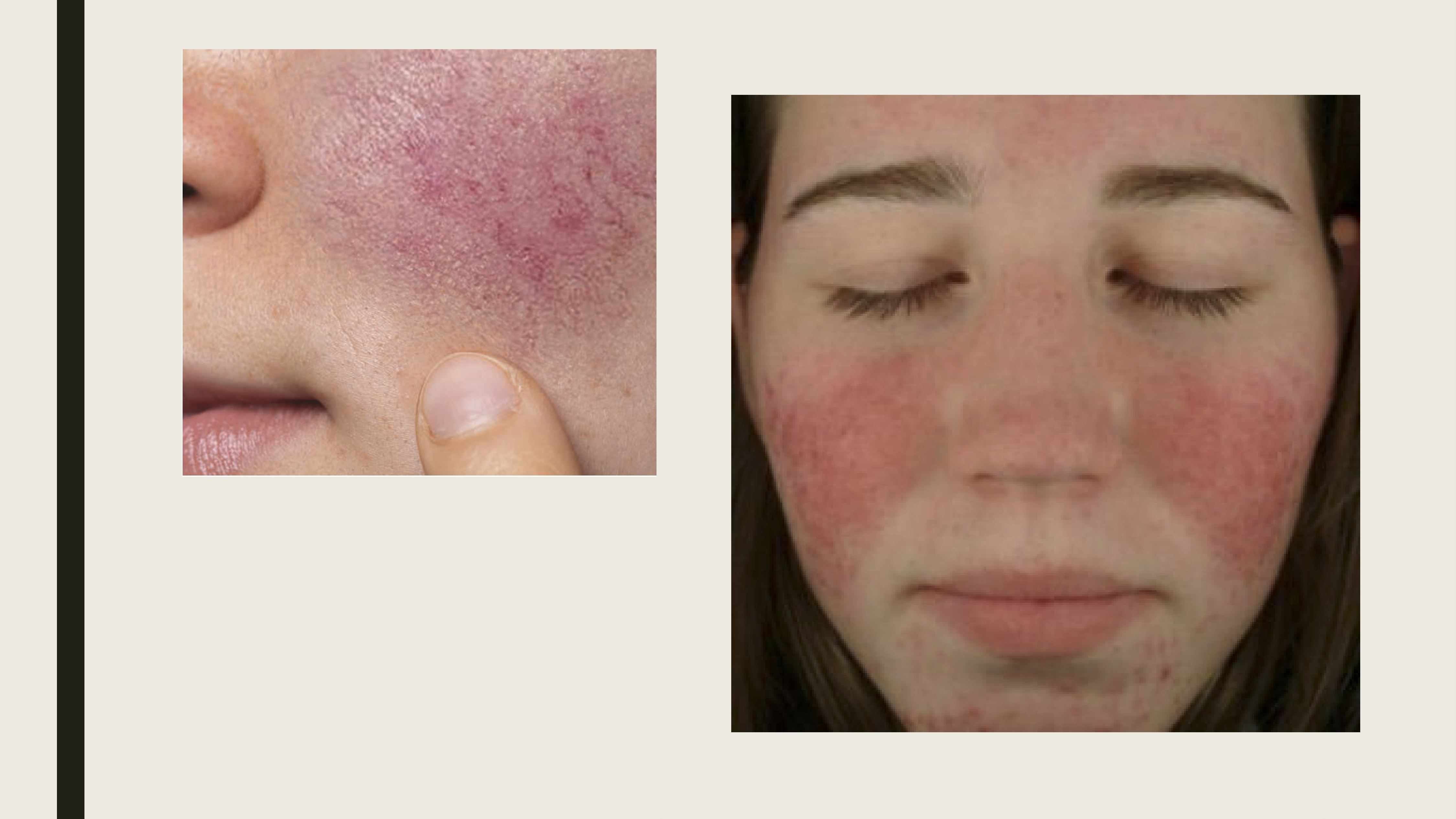 <ul><li><p>Red patches in the center of the face, nose and cheek area</p></li><li><p>Small blood vessels become dilated and visible</p><ul><li><p>On the face, eyuelid, or eye</p></li></ul></li><li><p>Swollen red bumps-resemble acne</p></li><li><p>Enlarged nose </p></li></ul><p></p>