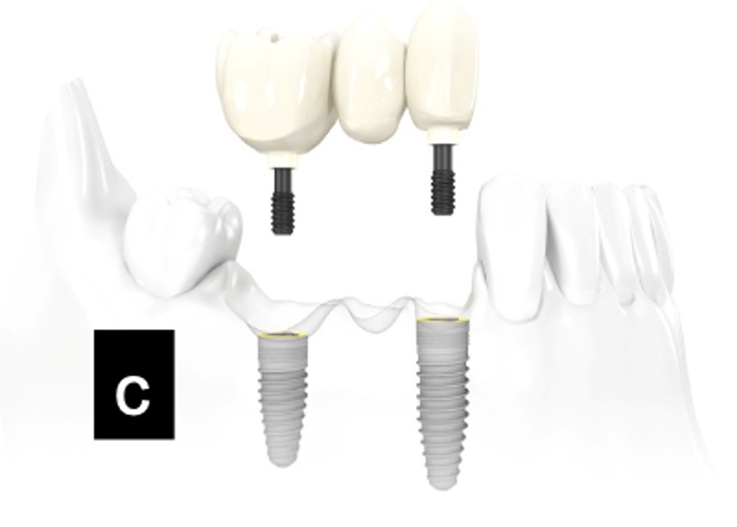 <p>What type of implant does this show?</p>