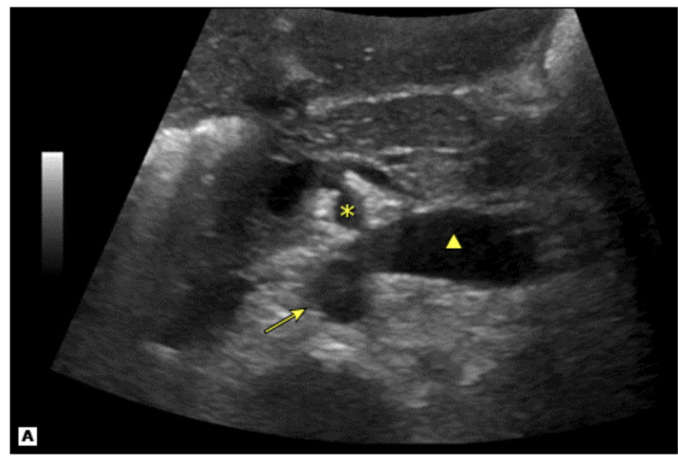 <p>12 y/o boy presents to the ED for left flank pain. His mother states that he just grew 2 inches. Vitals are stable. On physical exam you note left varicocele. UA reveals hematuria. U/S reveal <span>demonstrates significant narrowing between the superior mesenteric artery and the aorta. What is your treatment plan?</span></p>