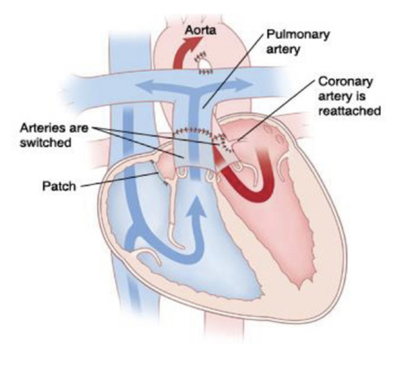 <p>deoxygenated blood circulates body, causing severe cyanosis and organ death</p><p>Blood MUST be mixed ASAP through an open shunt (PDA)</p>