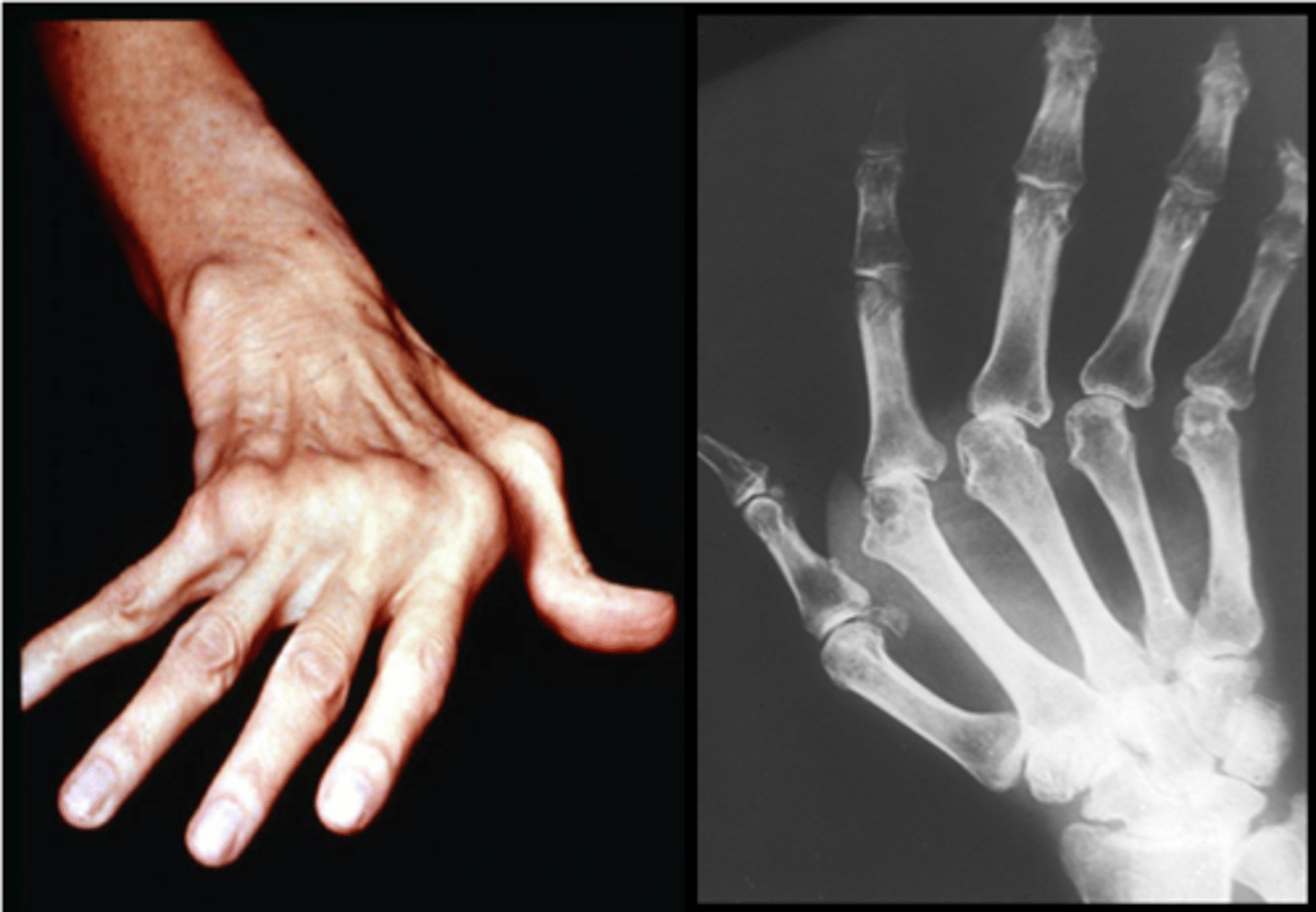 <p>most common sites of subluxation are the wrist and MCP joints</p><p>(volar subluxation of the MCP joints occurs frequently and is often accompanied by ulnar drift and lateral displacement of the extensor tendons)</p>