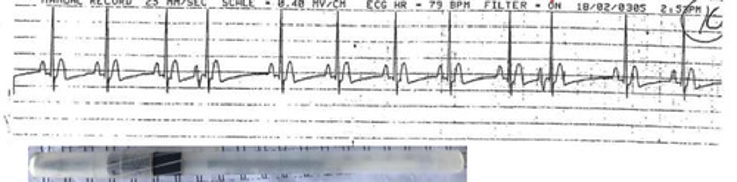 <p>How do you know that the PAC came from an ectopic location?</p>