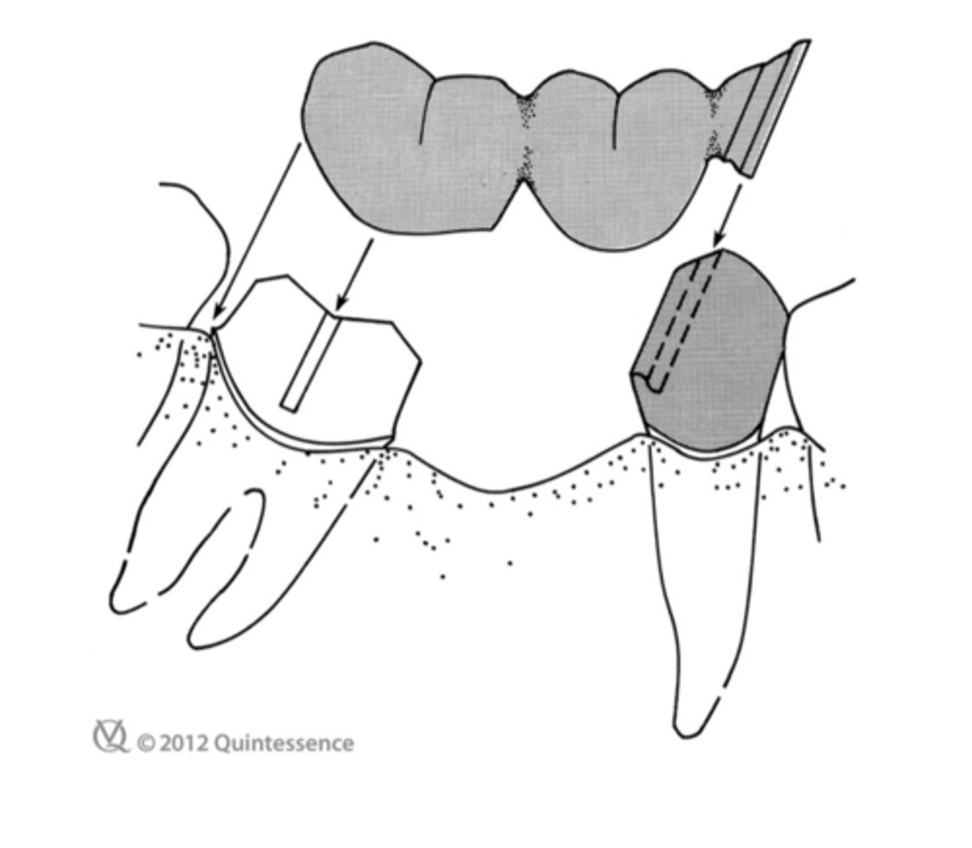 <p>What is on the distal aspect of the premolar retainer that compensates for the inclination of the tilted molar?</p>