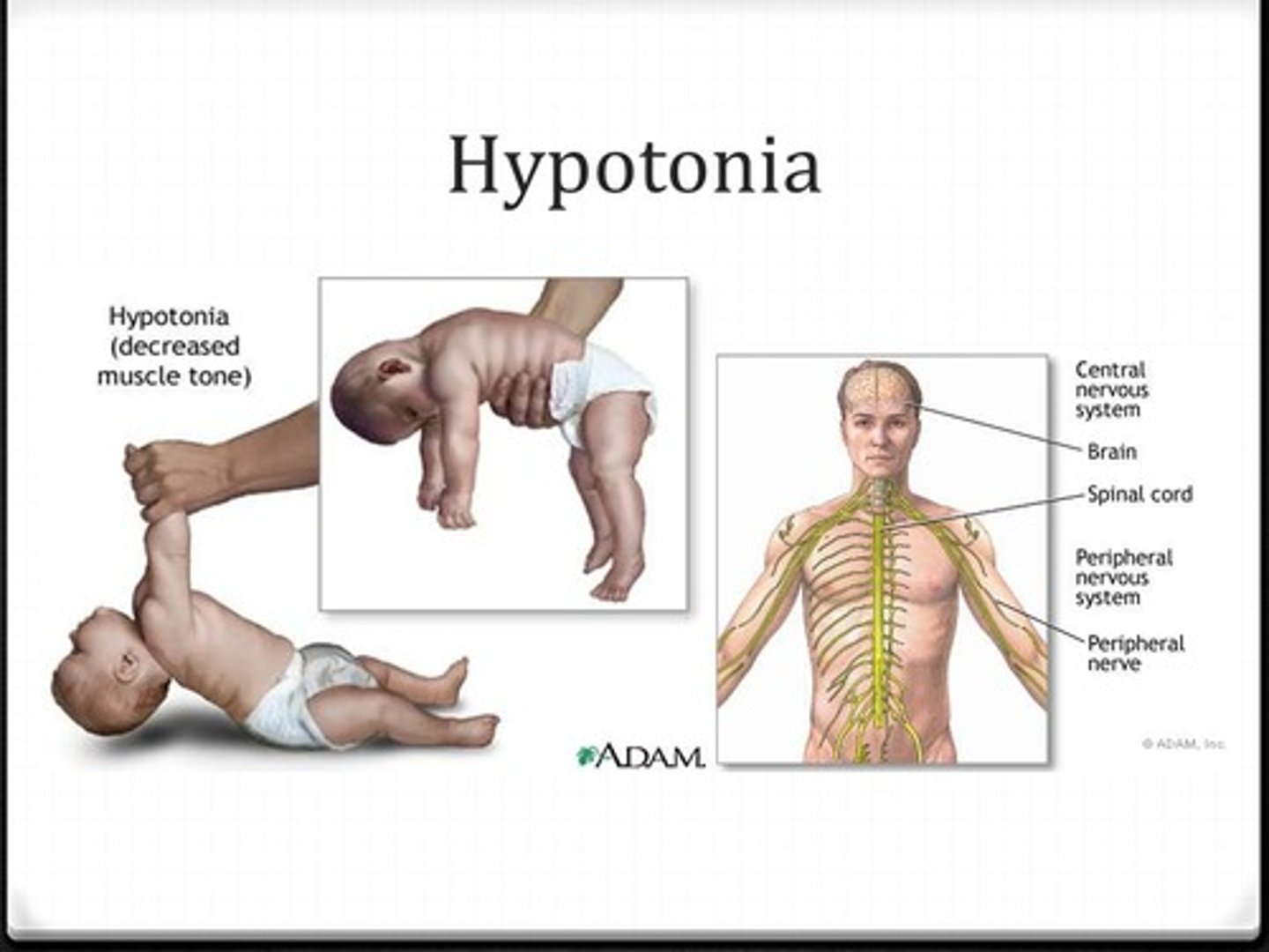 <p>Atrophy is when skeletal muscles actually decrease in size.</p><p>Hypotonia is when skeletal muscles have less tone, meaning that the muscles are not as contracted at rest</p>