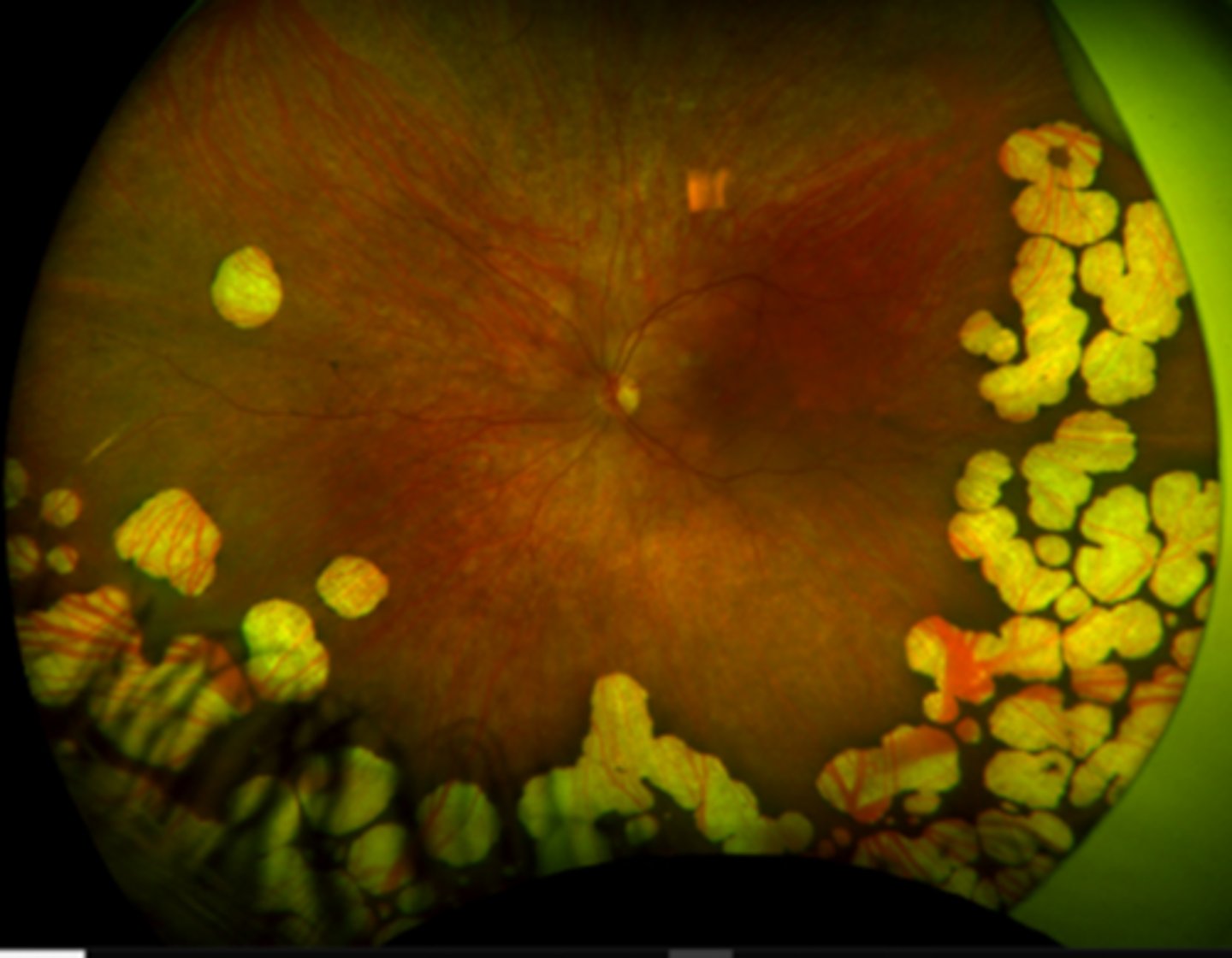 <p>nyctalopia</p><p>peripheral VF loss</p><p>VA loss</p>