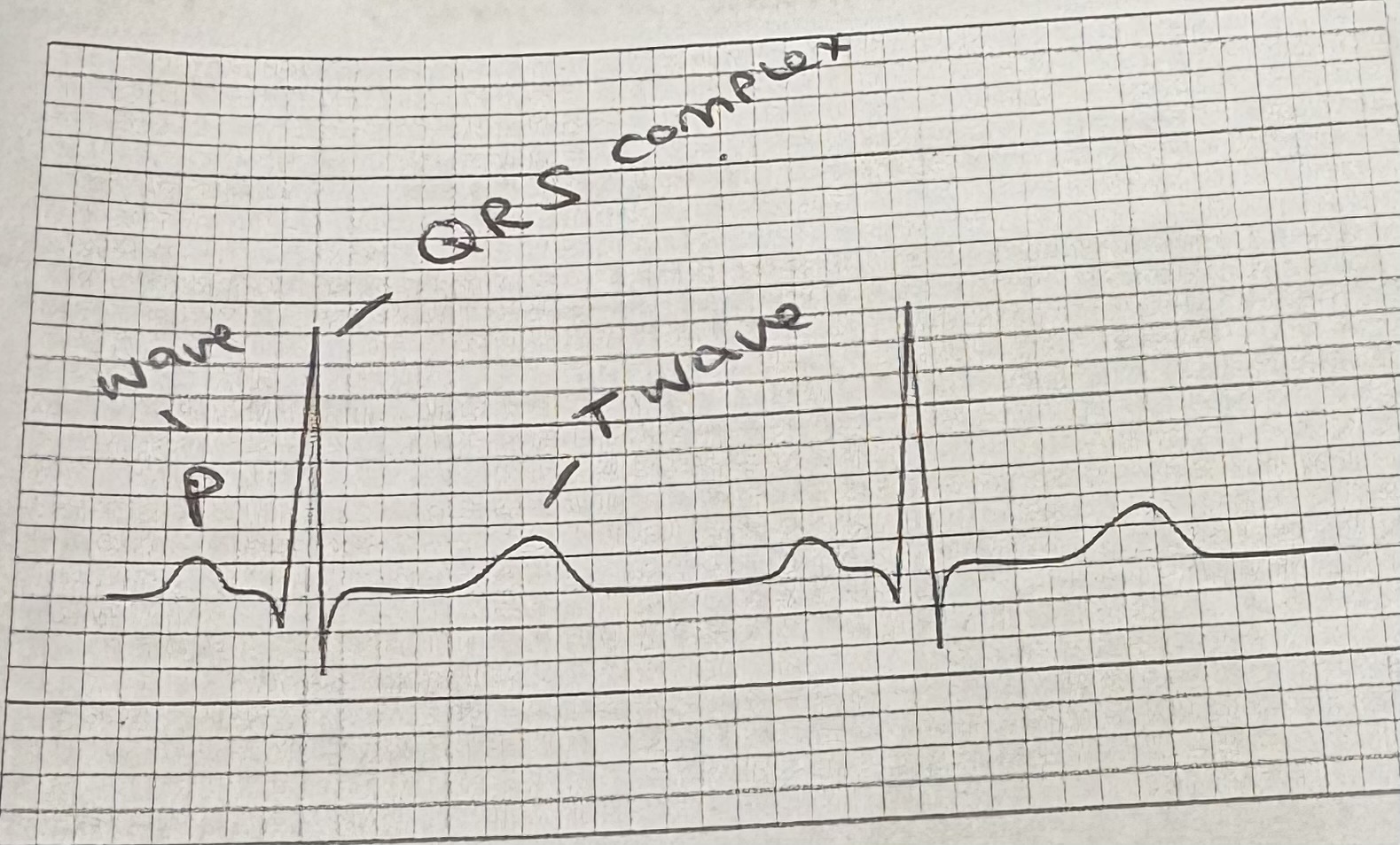 <p>What factors would affect this normal ECG? </p>