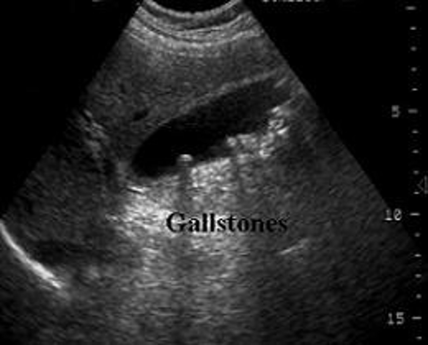 <p>- mobile, echogenic structure within GB lumen that produces posterior shadowing</p><p>-WES sign if completely filled with stones</p><p>-change in patient position that shows movement</p><p>-some stones may adhere to the wall and not cause shadow- twinkle artifact may be used to differentiate b/w a small stone and polyp:</p><p>-twinkle occurs posterior to a strong, granular surface like crystals or calcifications</p>