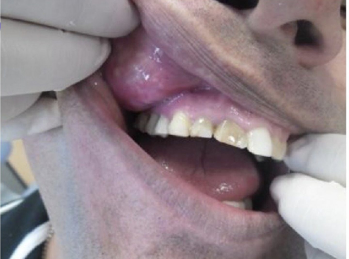 <p>nasopalatine duct cyst</p>