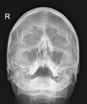 canthomeatal plane forms 37 angle with image receptor, pt faces receptor