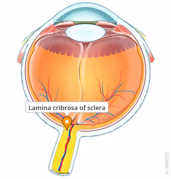 <p>A <strong>sieve-like part of the sclera</strong> where the <strong>optic nerve exits</strong>.</p>