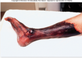 <p>what are the risk factors for gas gangrene/<em>Clostridium perfringens (</em>obligate anaerobe)</p>