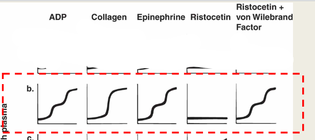 <ul><li><p>ADP: norm</p></li><li><p>Epinephrine: norm</p></li><li><p>Collagen: norm</p></li><li><p>Ristocetin: abnormal</p></li><li><p>Ristocetein +NL plasma: norm</p></li></ul><p></p>