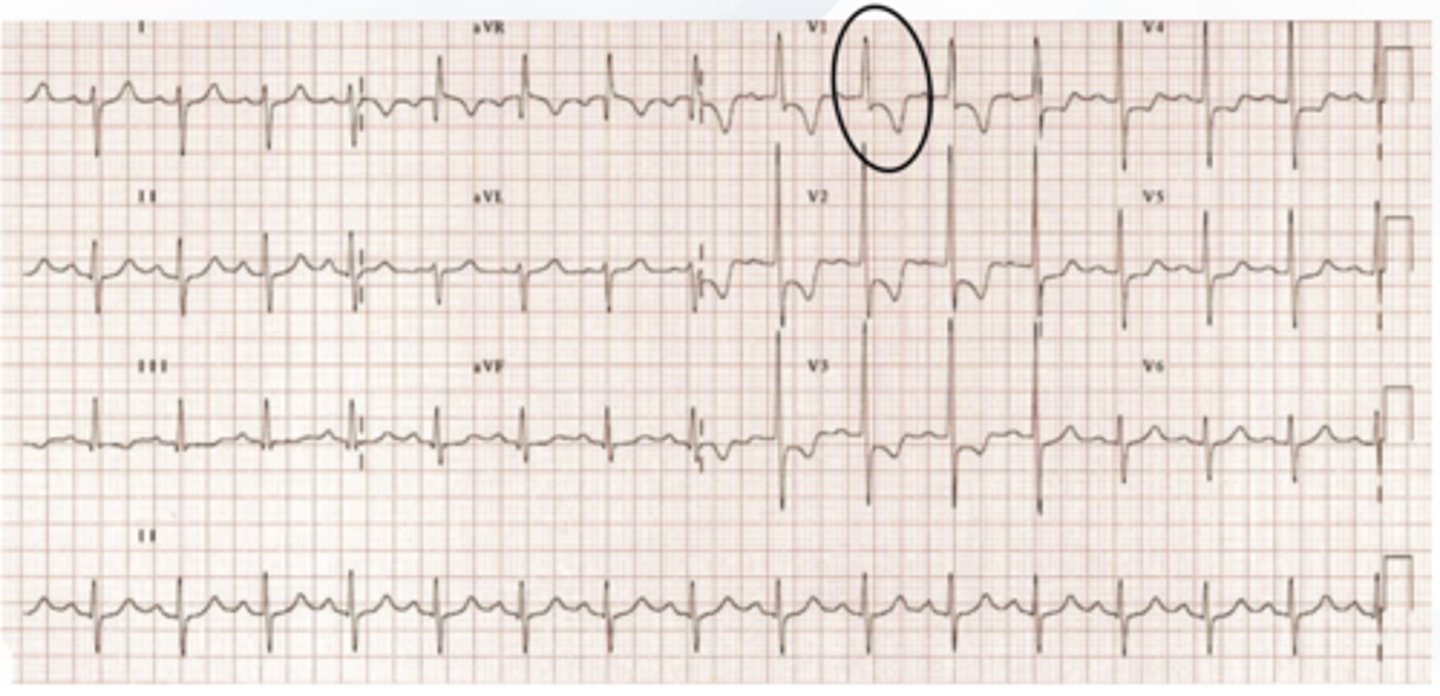 <p>- tall R waves followed by ST depression and T wave inversion in V1-V3</p><p>- formerly called "strain pattern"</p>