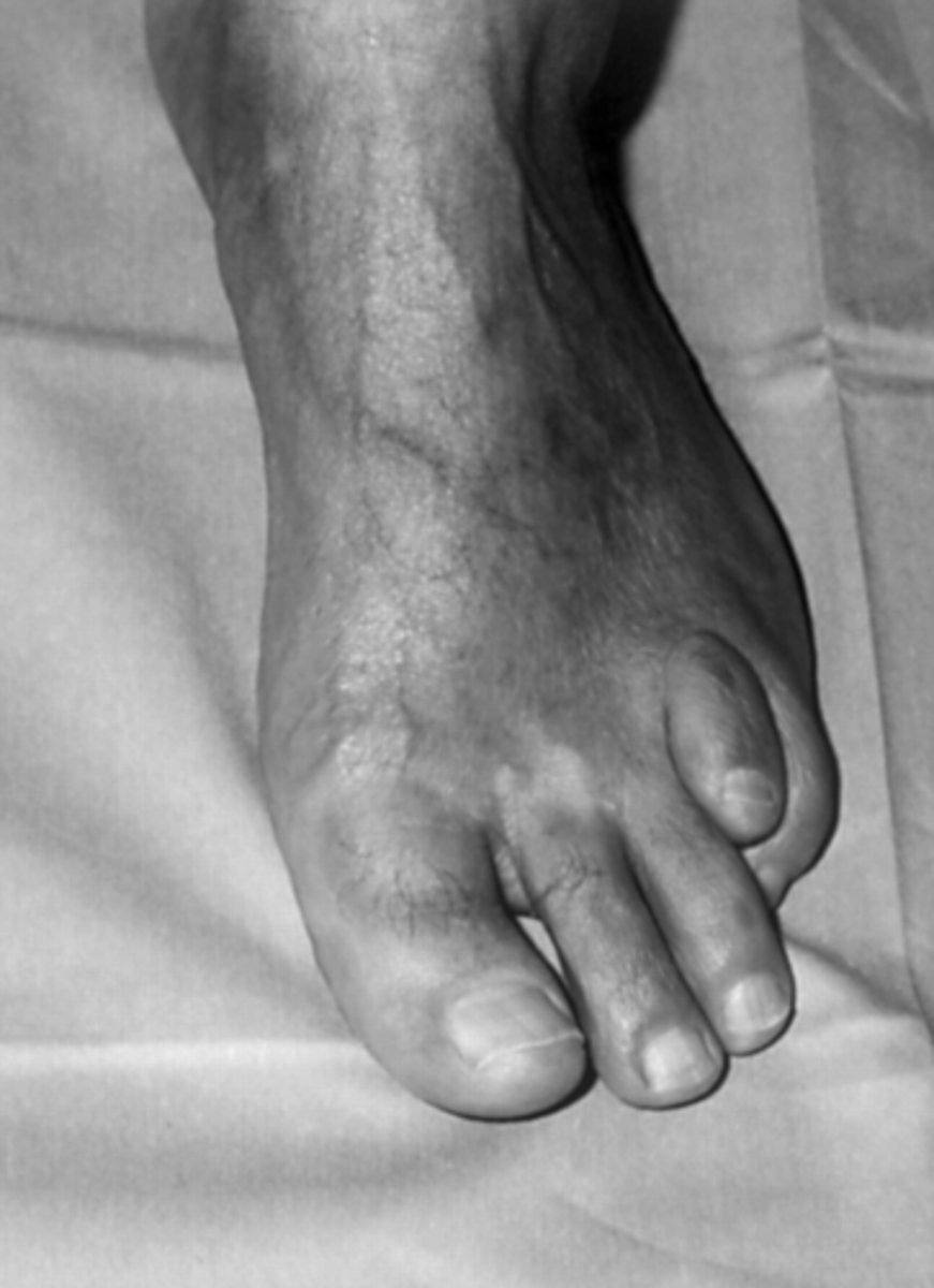 <p>RP vision loss</p><p>anosmia = loss of sense of smell</p><p>bone abnormalities in hands/feet</p><p>progressive mm wasting</p><p>poor balance/coordination</p><p>hearing loss</p><p>dry, scaly skin</p><p>cardiac arrhythmias</p>