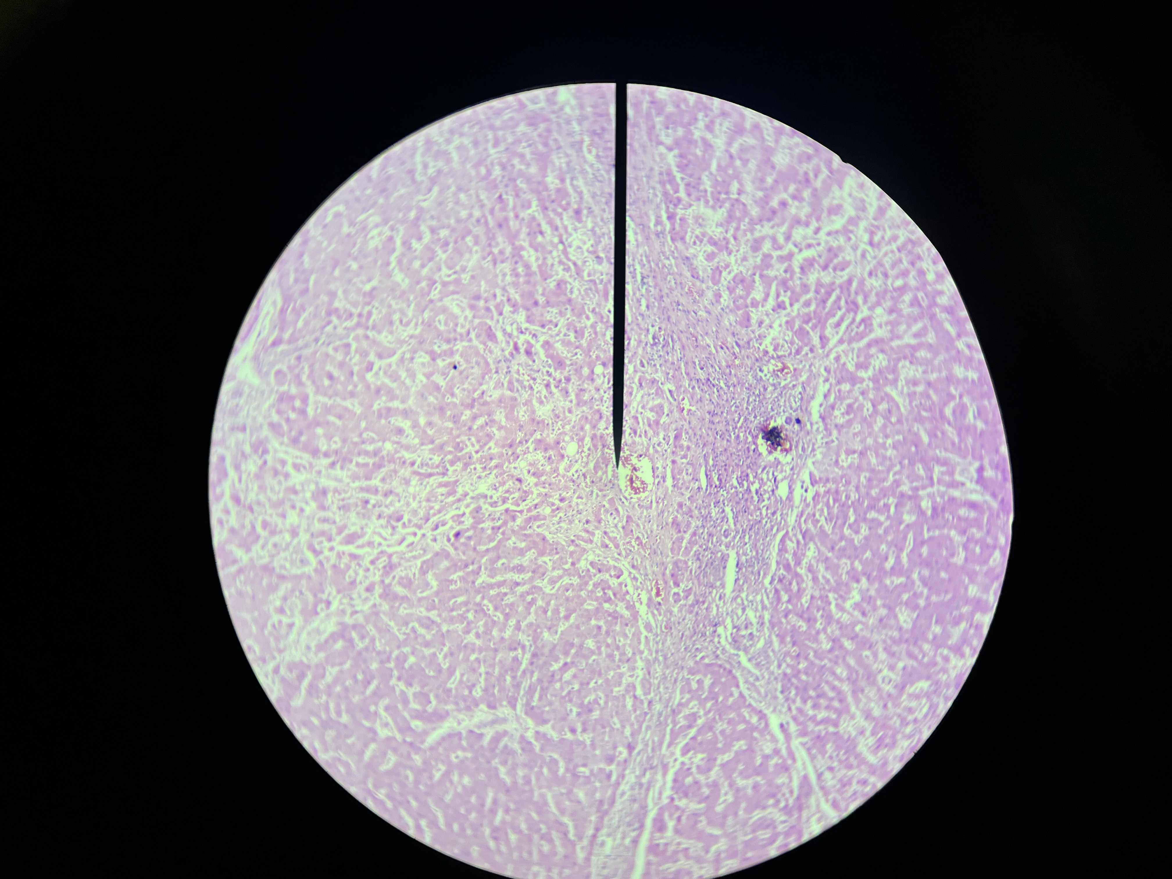 <p><span>include widespread fibrosis, formation of regenerative nodules, and distortion of the normal liver architecture. There may also be associated features of portal hypertension and necrosis of liver cells.</span></p>