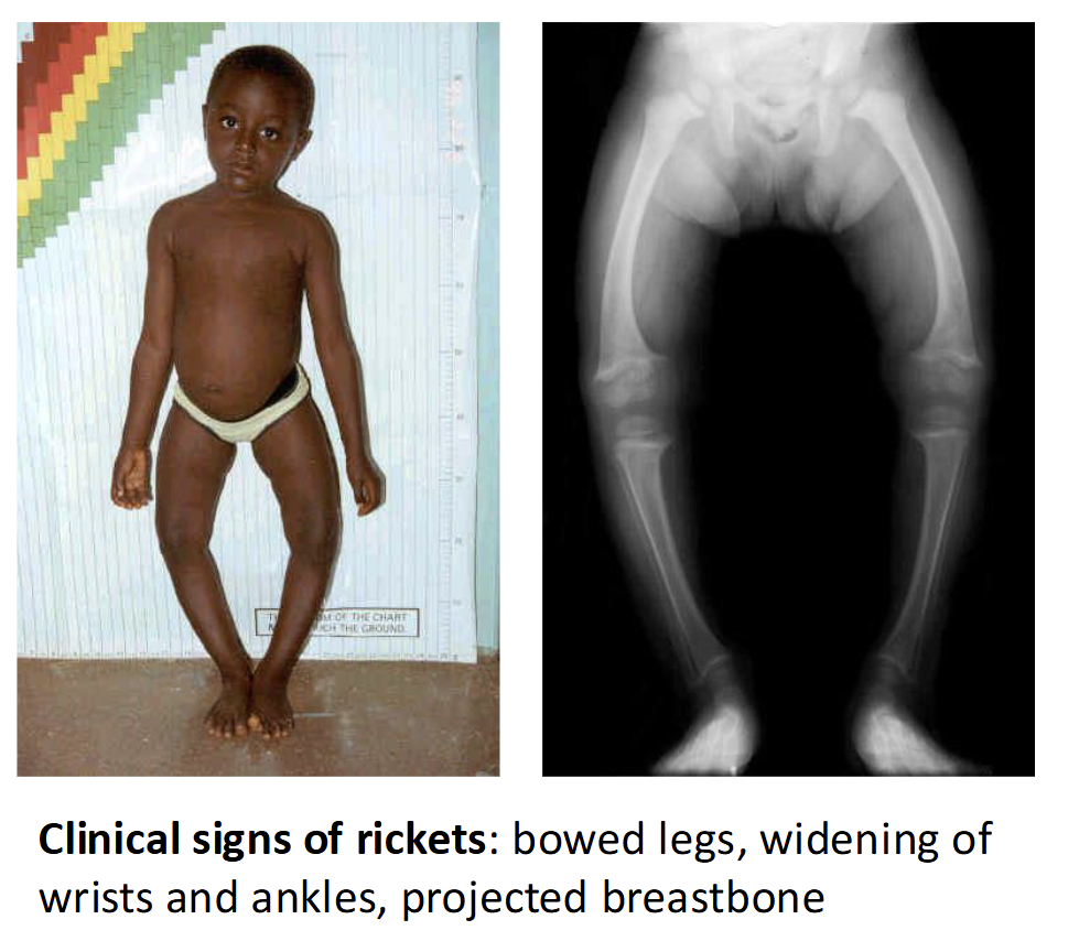 <p>Rickets - inadeqaute bone mineralization in early life(children) leading to softened</p><p>Osteomalacia - softening of bones due to inadequate bone mineralization in later years(adults)</p><p>Osteoprossis - demineralization of previously healthy bone; weak brittle porous bone</p>