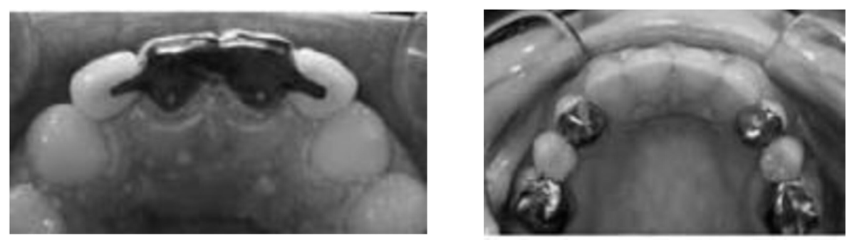 <p></p><p>Retention success relies on bond strength and the cement lute, therefore:</p><ol><li><p>Extend the retainer wing over maximum available enamel (including occlusal)</p><p></p></li></ol><p></p>