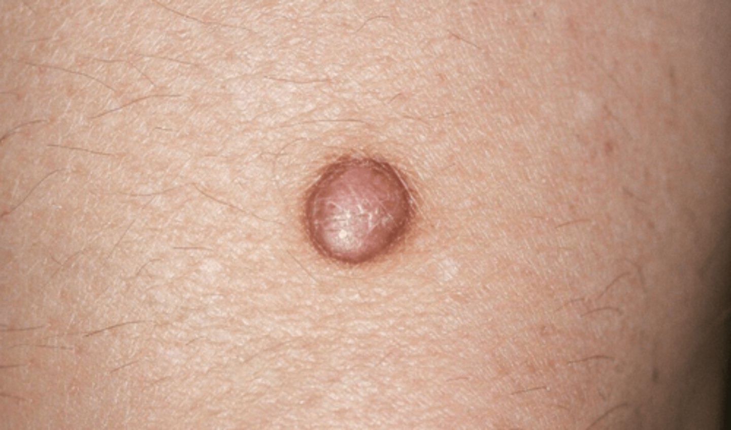 <p>-Elevated, firm, circumscribed lesion, larger/deeper than papule</p><p>-Located in dermis, subcutaneous tissue, or epidermis</p><p>-1/2 cm or more</p><p>Example:</p><p>-Dermatofibroma</p>