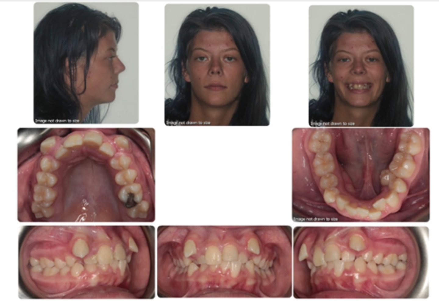 <p>What type of malocclusion does she have?</p>