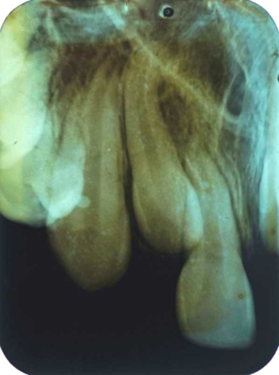 <p>-Film stuck together in the developer prevented from reaching emulsion (green)</p><p>-Common in using double film (2/pack). The 2nd film did not get separated prior to developing it.</p>