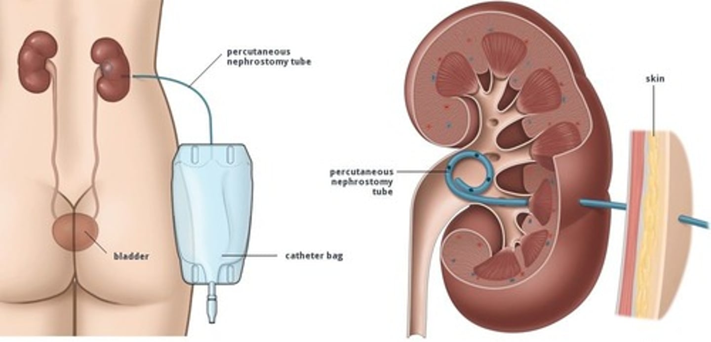 <p>how would you treat a pt with a ureteral obstruction that cannot get a ureteral stent placed?</p>