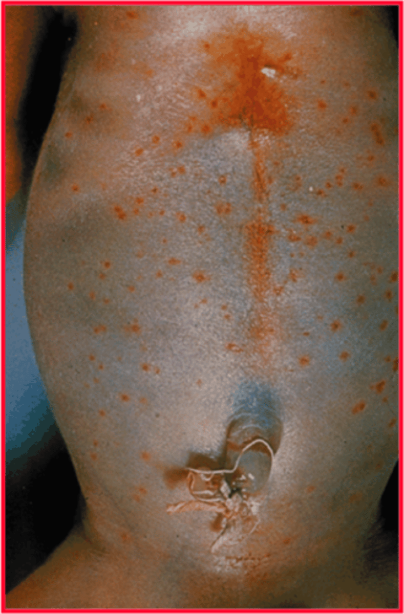 <p>result of listeria in neonate</p><p>•Disseminated abscesses or granulomas in multiple organs</p><p>•Most are stillborn or die soon after birth</p>