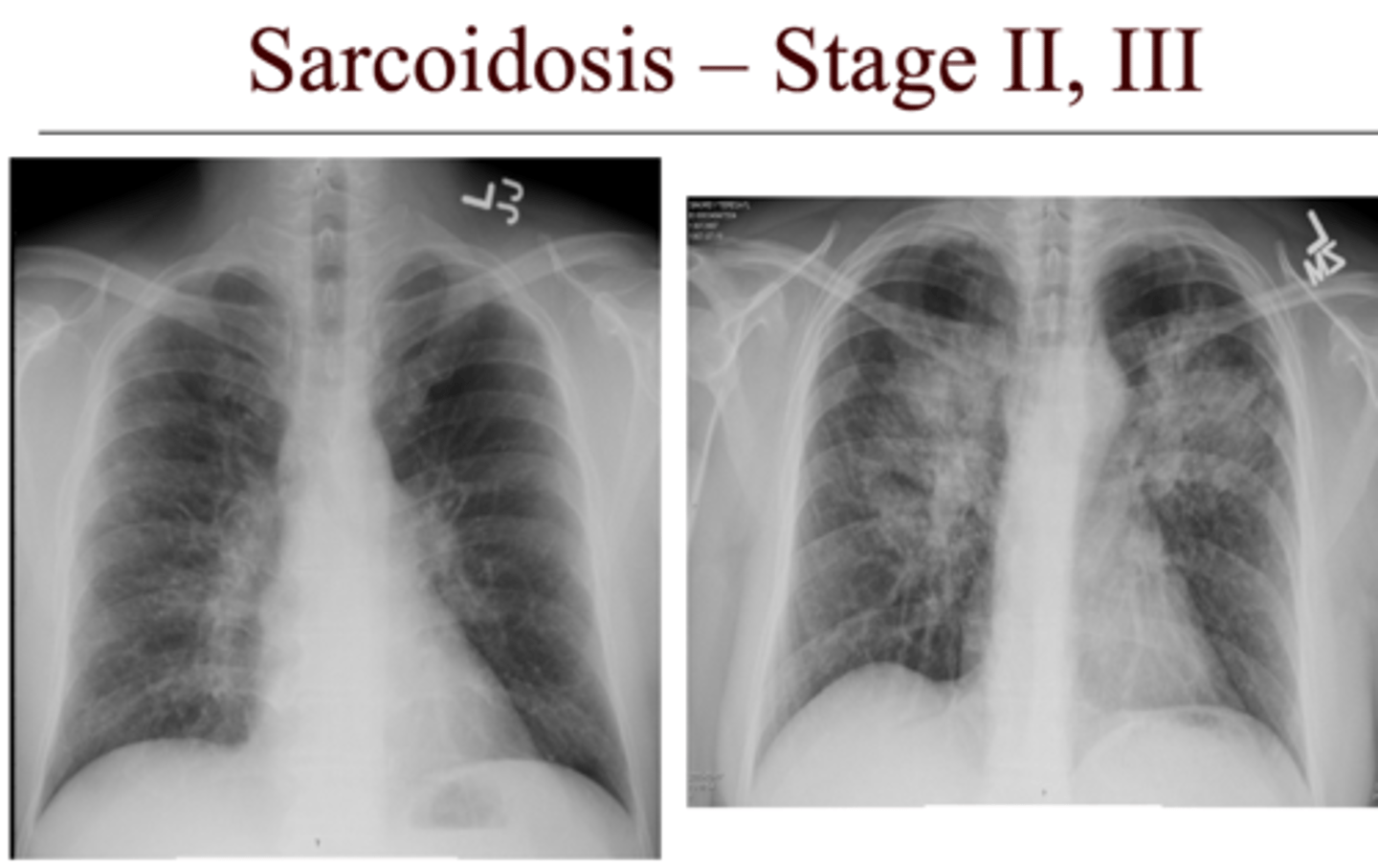 <p>-<b>stage 1=hilar adenopathy--&gt; best prognosis</b><br><br>-stage 2= adenopathy + infiltrates<br><br>-stage 3= infiltrates (interstitial lung disease)<br><br>-<b>stage 4=fibrosis--&gt; worse prognosis</b></p>