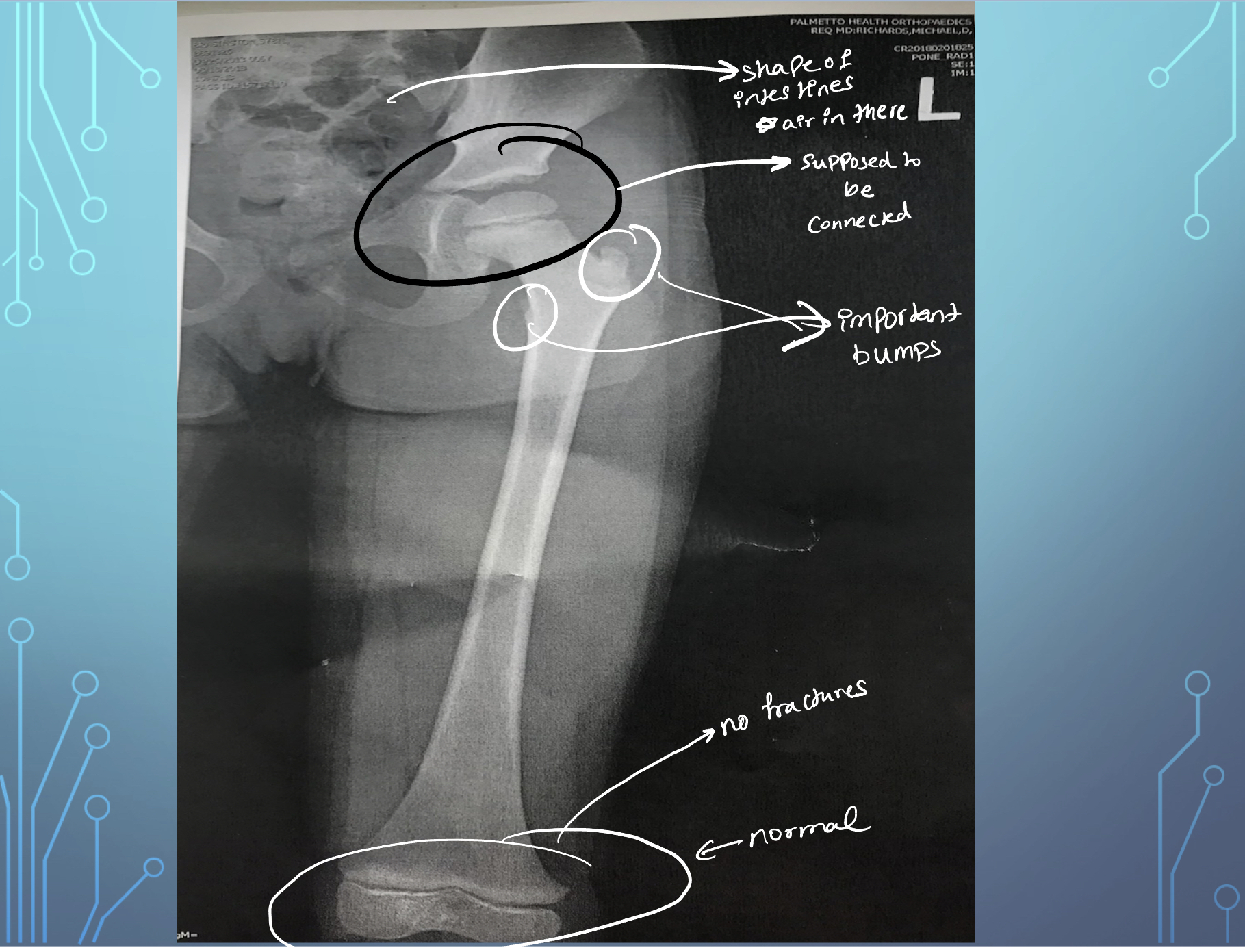 **Patient Case:**

* Know that the bones in xray are not broken, but are just developing
* They will eventually connect
* The two bumps circled are important
