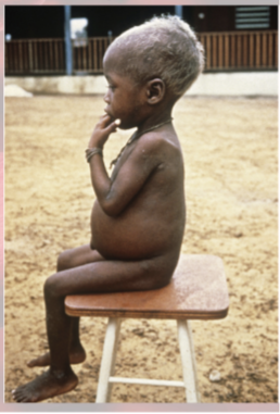 <p>in children with severe protein deficiency</p><ul><li><p>fed on cereals once weaned—swollen abdomen</p></li></ul><p></p>