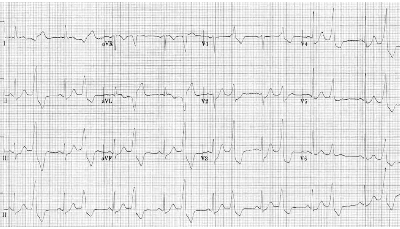 <p>How does one treat PVCs in a healthy person?</p>