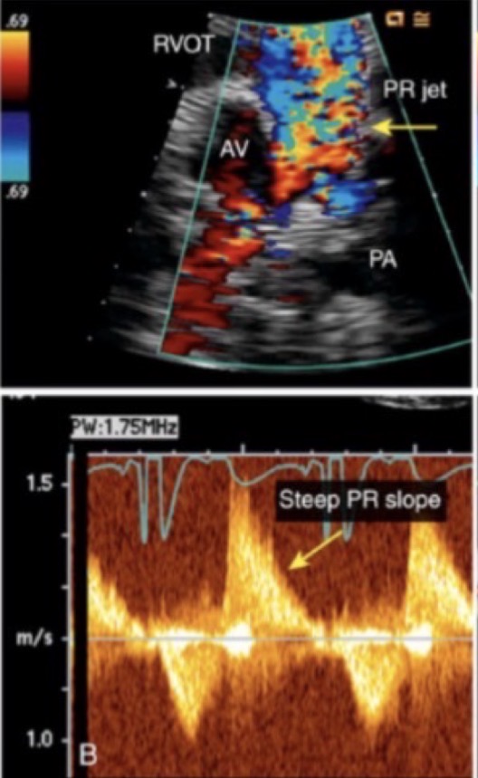 <p>What grade of PR is this</p>