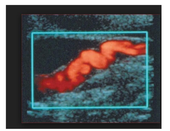 <p>Whats FMD, fibromuscular dysplasia, what does it mostly affect</p>