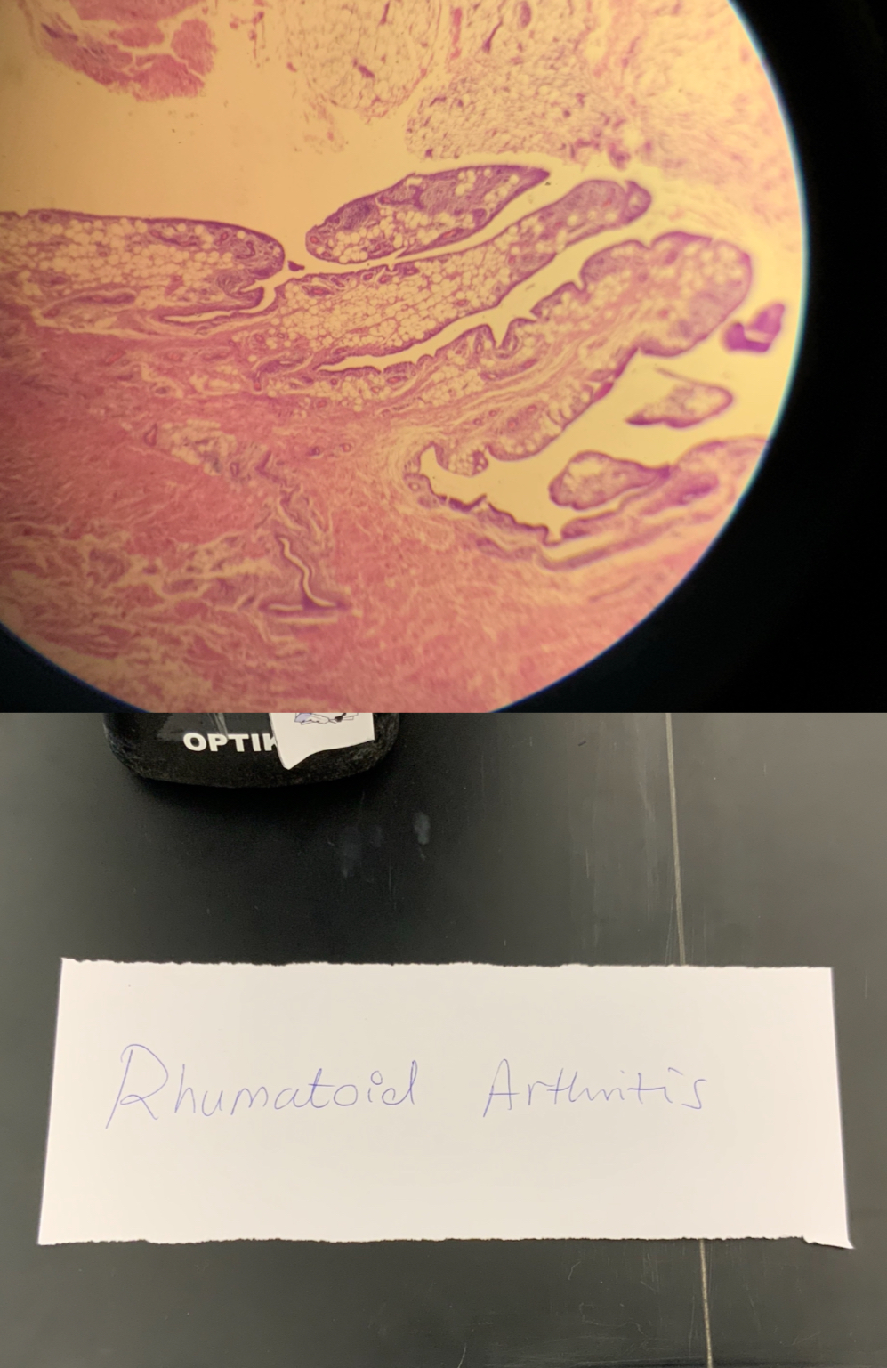 <p><strong>A chronic autoimmune inflammatory disease affecting synovial joints symmetrically.</strong></p><p class="p2"></p><p class="p1"><strong>Epidemiology</strong></p><p class="p1"><strong>• Females > males (3:1)</strong></p><p class="p1"><strong>• Peak age: 30–50 years</strong></p><p class="p2"></p><p class="p1"><strong>Pathogenesis</strong></p><p class="p1"><strong>• Autoimmune reaction mediated by CD4+ T cells</strong></p><p class="p1"><strong>• Cytokines involved: TNF-α, IL-1, IL-6</strong></p><p class="p1"><strong>• Autoantibodies:</strong></p><p class="p1"><strong>• Rheumatoid Factor (RF)</strong></p><p class="p1"><strong>• Anti-CCP (ACPA)</strong></p><p class="p2"></p><p class="p1"><strong>Pathologic Features</strong></p><p class="p1"><strong>• Synovial hyperplasia</strong></p><p class="p1"><strong>• Pannus formation</strong></p><p class="p1"><strong>• Cartilage destruction</strong></p><p class="p1"><strong>• Bone erosion → ankylosis</strong></p><p class="p2"></p><p class="p1"><strong>Clinical Features</strong></p><p class="p1"><strong>• Symmetric joint involvement</strong></p><p class="p1"><strong>• Morning stiffness >1 hour</strong></p><p class="p1"><strong>• MCP &amp; PIP joints affected</strong></p><p class="p1"><strong>• Deformities:</strong></p><p class="p1"><strong>• Ulnar deviation</strong></p><p class="p1"><strong>• Swan-neck</strong></p><p class="p1"><strong>• Boutonnière</strong></p><p class="p2"></p><p class="p1"><strong>Extra-articular Manifestations</strong></p><p class="p1"><strong>• Rheumatoid nodules</strong></p><p class="p1"><strong>• Lung involvement</strong></p><p class="p1"><strong>• Vasculitis</strong></p><p class="p1"><strong>• Anemia</strong></p><p class="p2"></p><p class="p1"><strong>Treatment:slow the course,induce remission,and prevent further destruction of the joints</strong></p><p class="p1"><strong>• Methotrexate (first-line)</strong></p><p class="p1"><strong>• TNF inhibitors</strong></p><p class="p1"><strong>• Adjuvant drugs:Corticosteroids and NSAIDs</strong></p><p class="p1"><strong>• DMARDs:classify into </strong></p><p class="p1"><strong>1)non-biological:</strong></p><p class="p1"><strong>-</strong>Immunosuppressants: methotrexate</p><p class="p1"><span>-Chloroquine or hydroxychloroquine</span></p><p class="p1"><span>-Leflunomide</span></p><p class="p1"><strong>2)biological:</strong></p><p class="p1"><span>-TNF inhibitors: etanercept. </span></p><p class="p1"><span>-Anti-interleukin 6 (IL-6): tocilizumab </span></p><p class="p1"><span>- Abatacept </span></p><p class="p1"><span>- Five Janus kinase (JAK) inhibitors: tofacitinib</span></p>