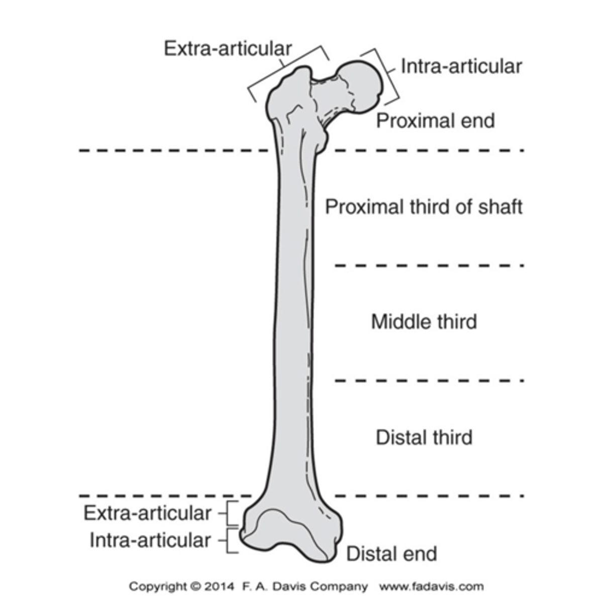 <p>- Intertrochanteric region of the femur</p><p>- Supracondylar of the distal femur</p>