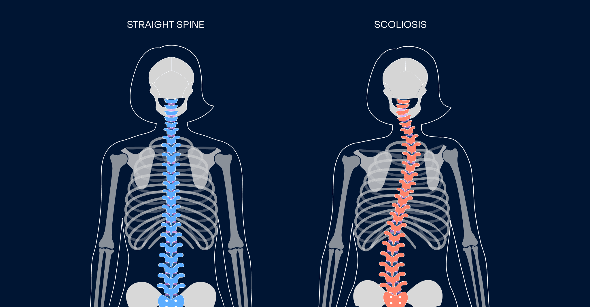 <p>Right or left lateral deviation in either thoracic or lumbar vertebrae&nbsp;</p>