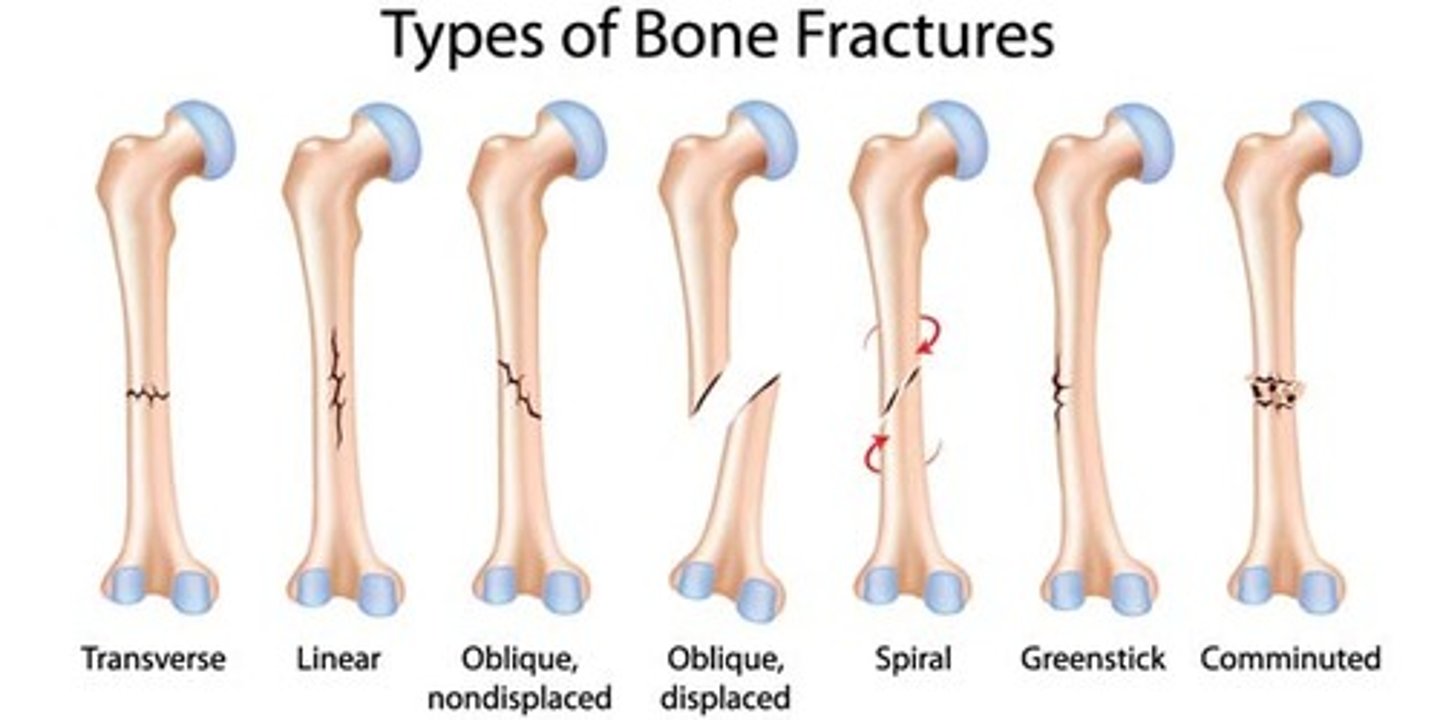 <p>Stress fracture: a break caused by abnormal trauma to a bone.</p><p>Pathological fracture: a break in a bone weakened by some other disease. </p><p>Nondisplaced fracture: the bone pieces remain in proper anatomical alignment.</p><p>Displaced: at least one piece has shifted out of alignment. </p><p>Comminuted: bone is broken into three or more pieces. </p><p>Greenstick: bone is incompletely broken on one side, just bent, the way a green twig breaks only partially. </p>