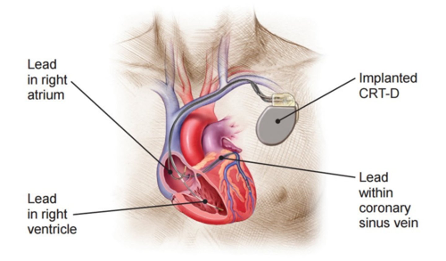 <p>Pacing technique that paces both ventricles to promote ventricular function in HF pts</p>