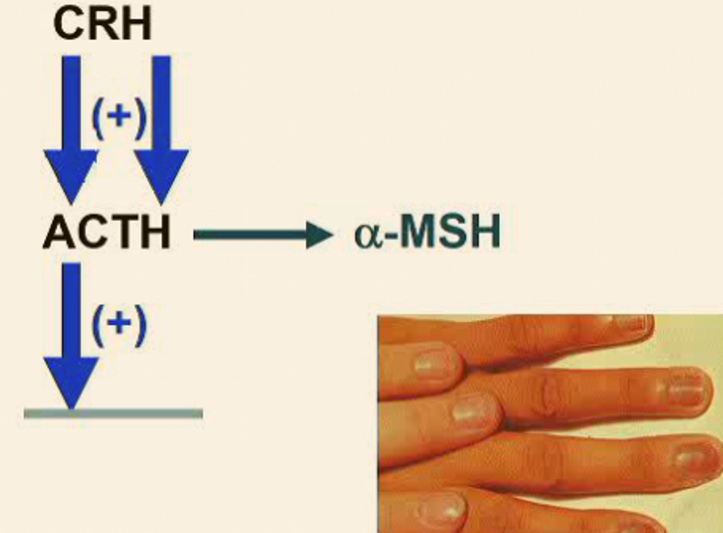 <p>Hypocortisolemia causes increased secretion of ACTH and other proopiomelanocortin -derived peptides such as MSH. These peptides stimulate melanin production, resulting in hyperpigmentation.</p>