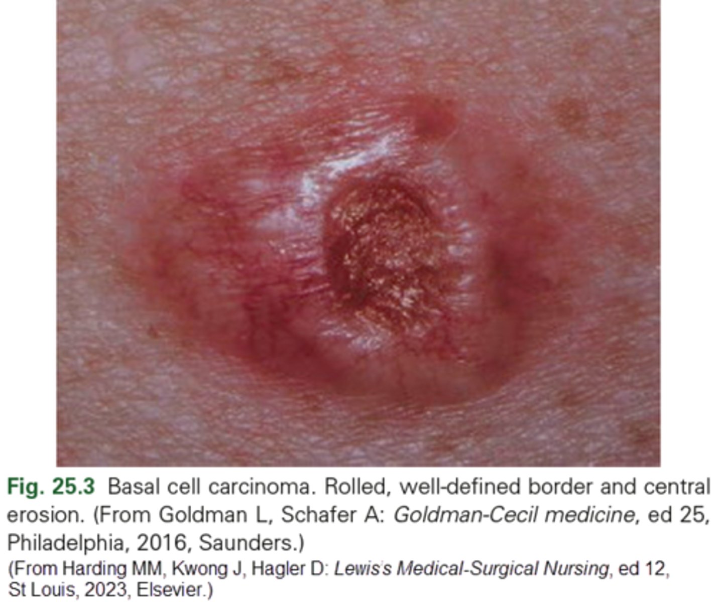 <p>d. Minimizing sun exposure will reduce risk for future BCC.</p><p>BCC is frequently associated with sun exposure and preventive measures should be taken for future sun exposure. BCC is a locally invasive malignancy arising from epidermal basal cells. It spreads locally (almost never spreading beyond the skin), and does not metastasize to distant tissues. Since BCC can cause local tissue destruction, treatment is indicated. Local (not systemic) chemotherapy may be used to treat BCC. BCC is the most common type of skin cancer and also the least deadly.</p><p>Pg 474</p>