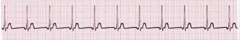 <p>regular rhythm; HR &gt;100 bpm; no P, inverted P, or post-QRS P wave</p>