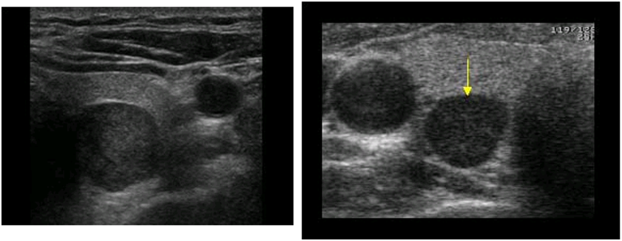 <p>small, solid, oval</p><p>homogenous</p><p>hypoechoic</p><p></p>